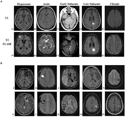 Neuro-imaging in intracerebral hemorrhage: updates and knowledge gaps
